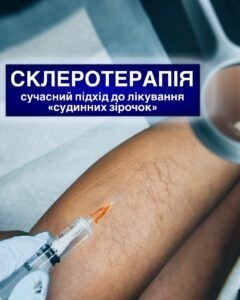 Склеротерапія: сучасний підхід до лікування «судинних зірочок»