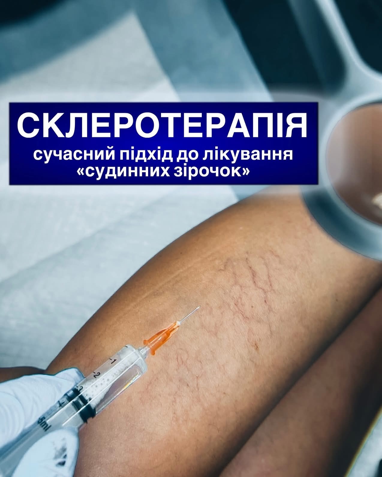 Склеротерапія: сучасний підхід до лікування «судинних зірочок» Склеротерапія: сучасний підхід до лікування «судинних зірочок»