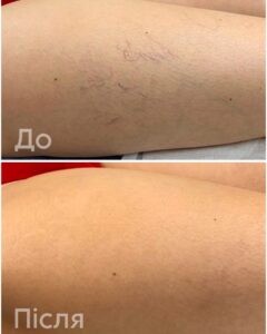 Склеротерапія: сучасний підхід до лікування «судинних зірочок»