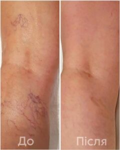 Склеротерапія: сучасний підхід до лікування «судинних зірочок»