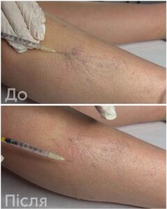 Склеротерапія: сучасний підхід до лікування «судинних зірочок»